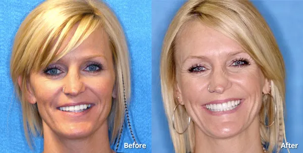Phoenix AZ patient before and after porcelain veneers at Harris Dental