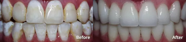 Phoenix patient's teeth after porcelain dental veneers from Harris Dental