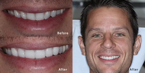 Phoenix man's before and after porcelain veneer photos