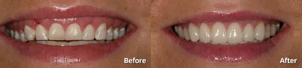 porcelain veneers with gingival recontouring from cosmetic dentists at Harris Dental in Phoenix