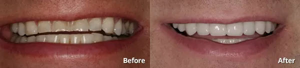 Before and after receiving porcelain dental veneers from Harris Dental in Phoenix AZ