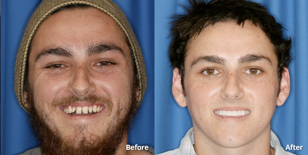 man shows his restored smile after receiving six prepless veneers from cosmetic dentist Harris Dental in Phoenix