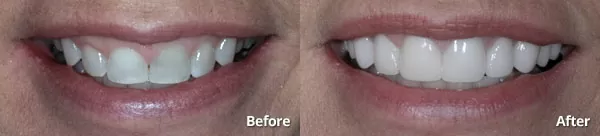 results of porcelain dental veneers from Phoenix cosmetic dentist at Harris Dental