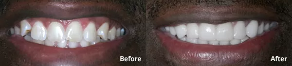 before and after porcelain veneers from Harris Dental Phoenix
