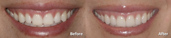 woman shows her six porcelain veneers from cosmetic dentists at Harris Dental Phoenix