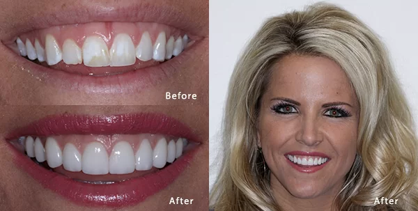 Woman shows transformed smile with porcelain veneers from Phoenix dentist at Harris Dental