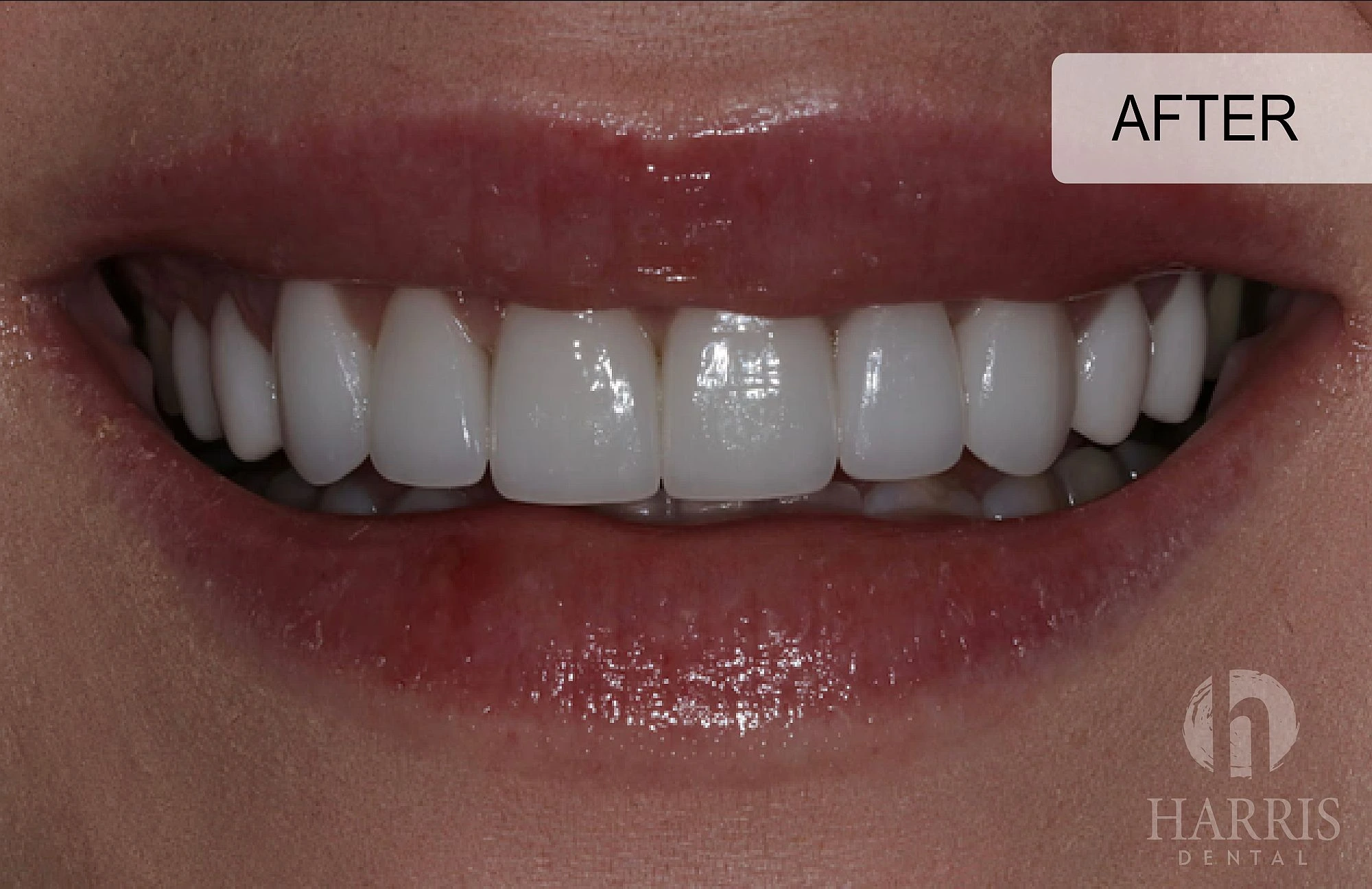 harrisdental-after two
