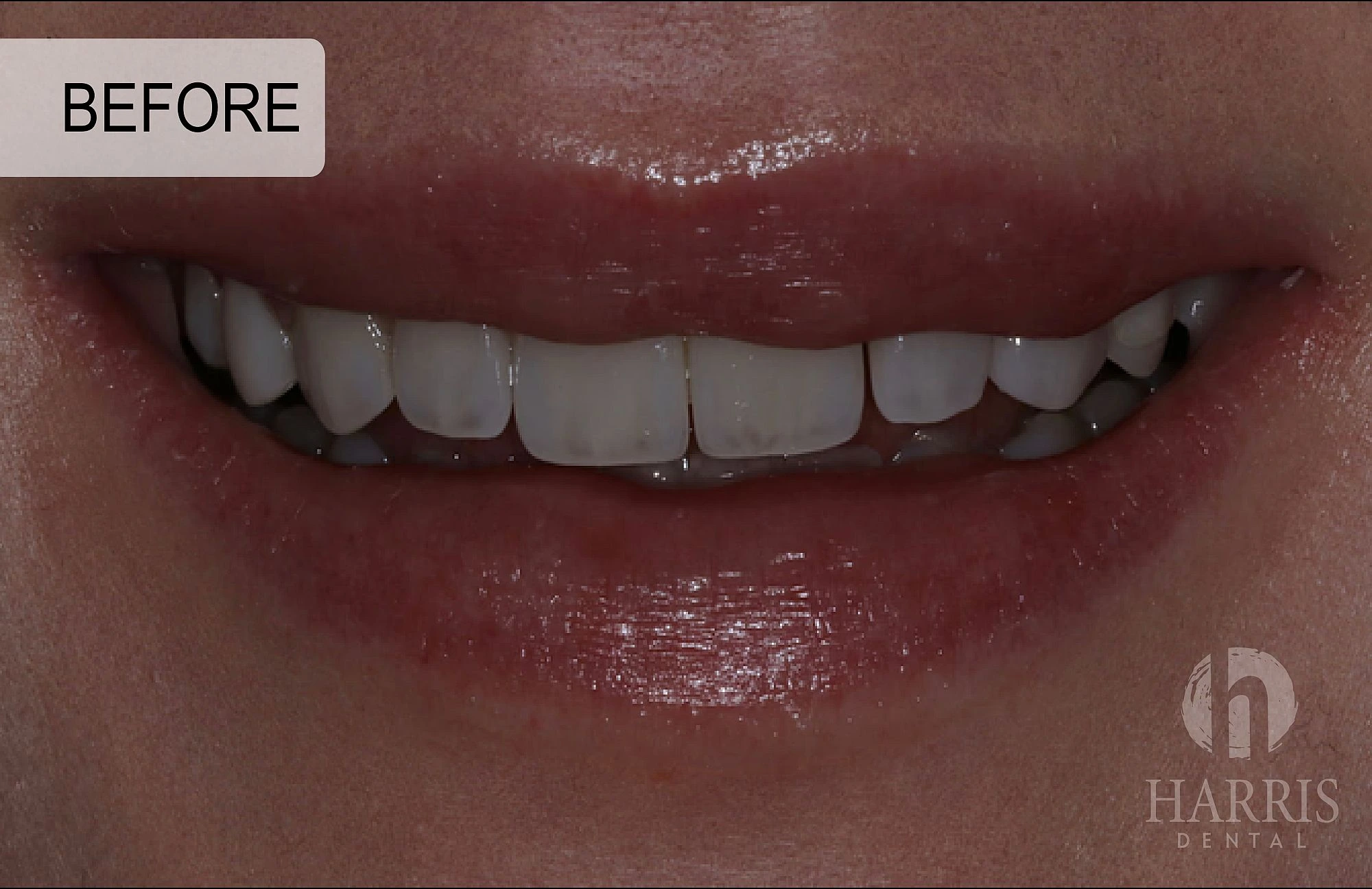 harrisdental-before-two