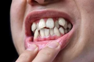 overlapping teeth in Phoenix, AZ