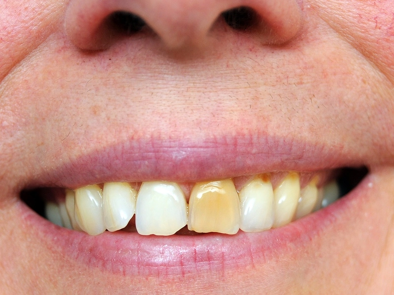Teeth Whitening Options at Harris Dental in the Phoenix area