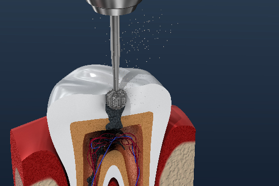 image of a drill going into the pulp of a tooth
