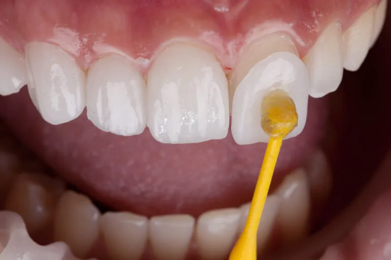up close of a veneer application