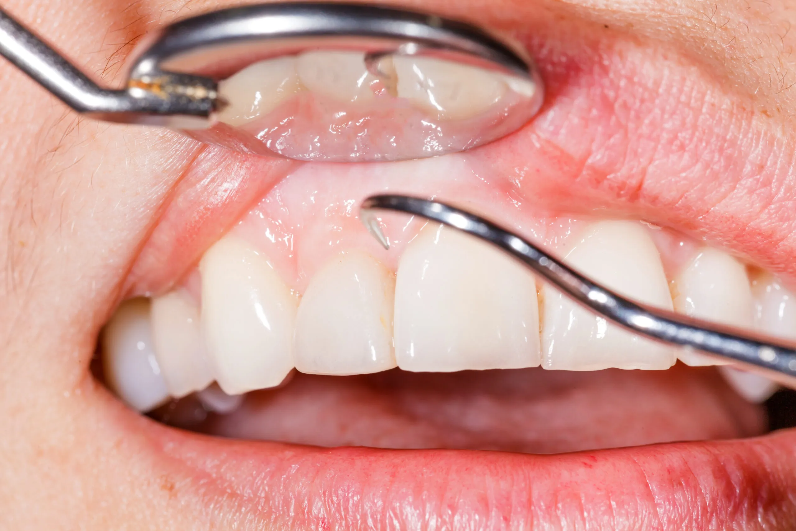 up close gum treatment