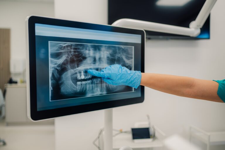 doctor showing a patient an impacted wisdom tooth in Phoenix