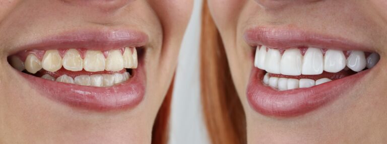 before and after of a professional teeth whitening procedure