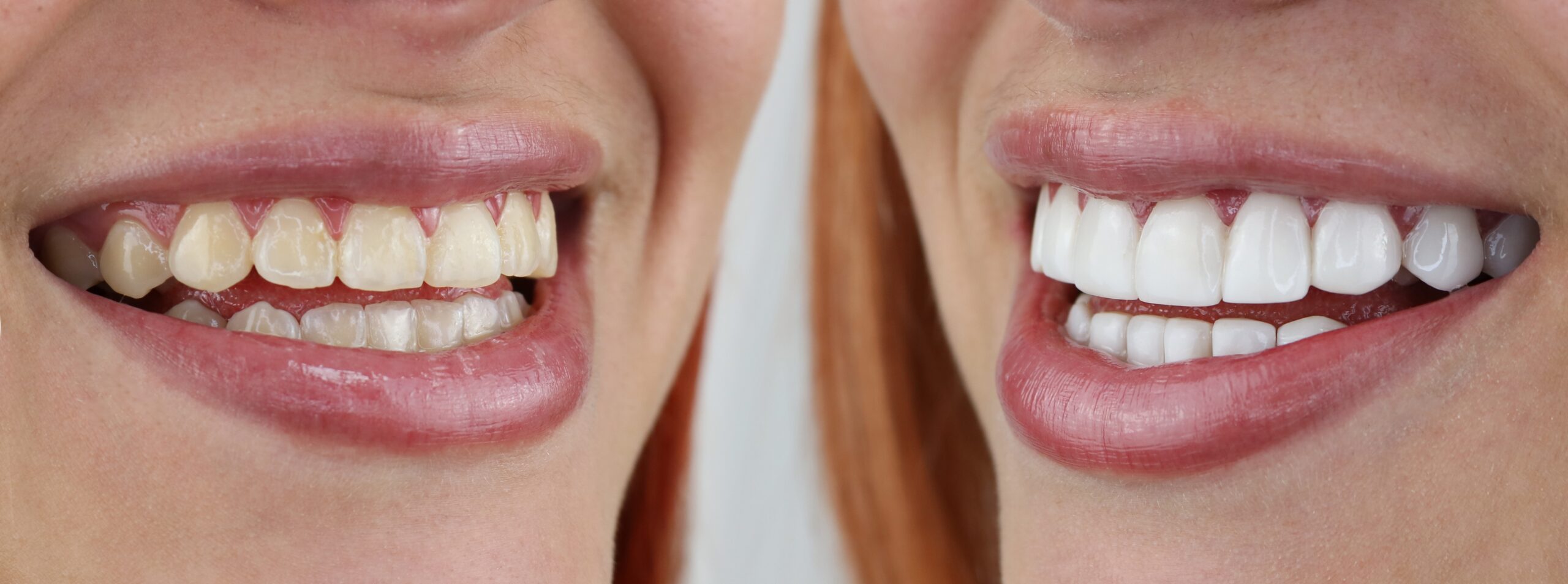 before and after of a professional teeth whitening procedure