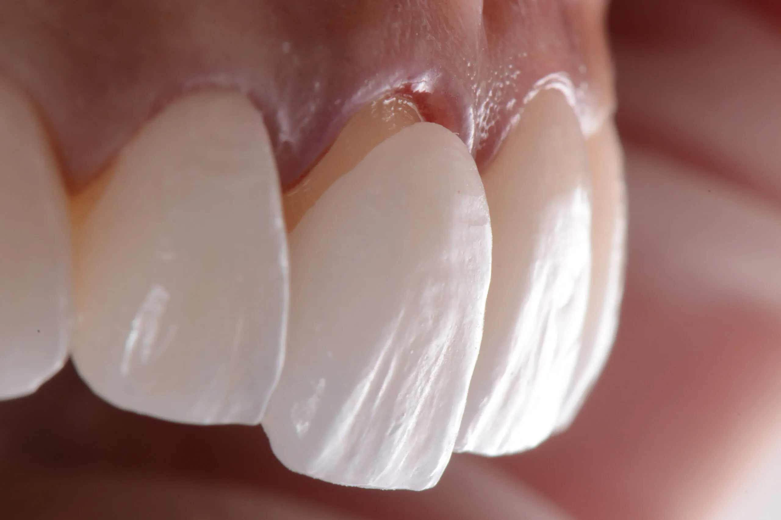 closeup of veneer application