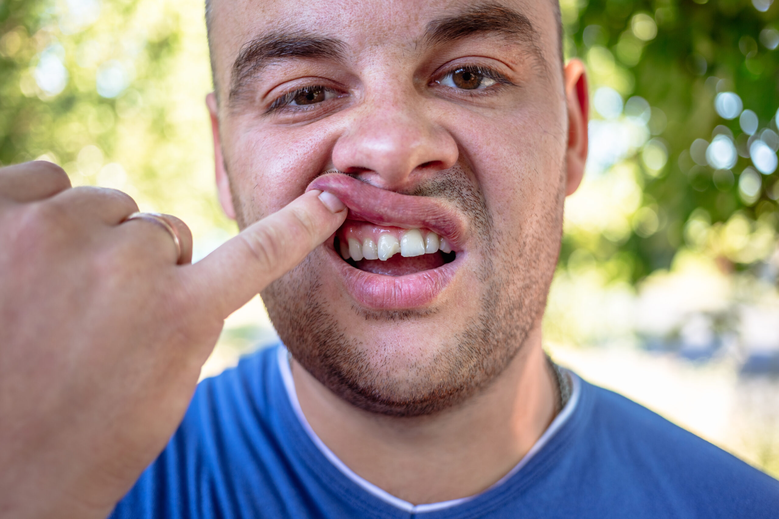 young man in a blue shirt exposing his chipped tooth