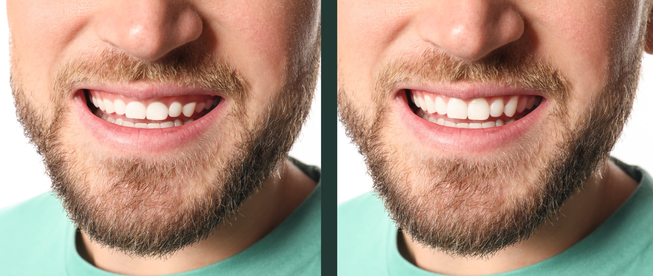 side by side of a gummy male smile fixed by laser dentistry