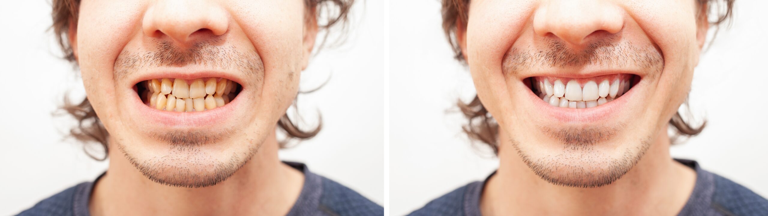 Close up portrait smile teeth man. Before and after teeth whitening,