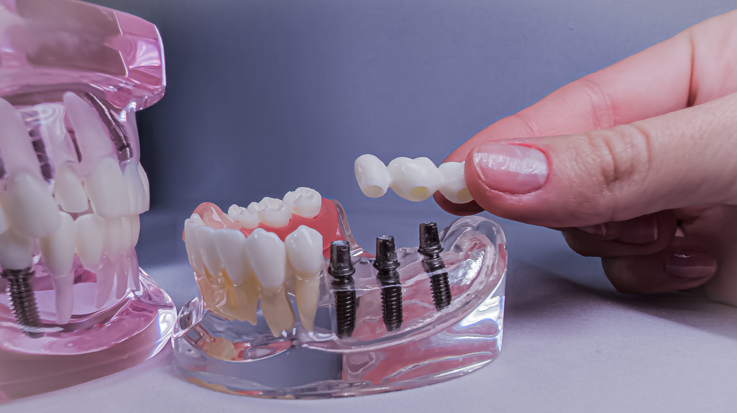 closeup of a dental implant model, posts