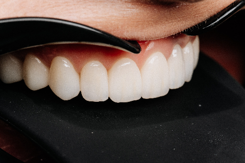 closeup of a dental veneer application